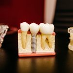 Quels matériaux pour une couronne dentaire ?